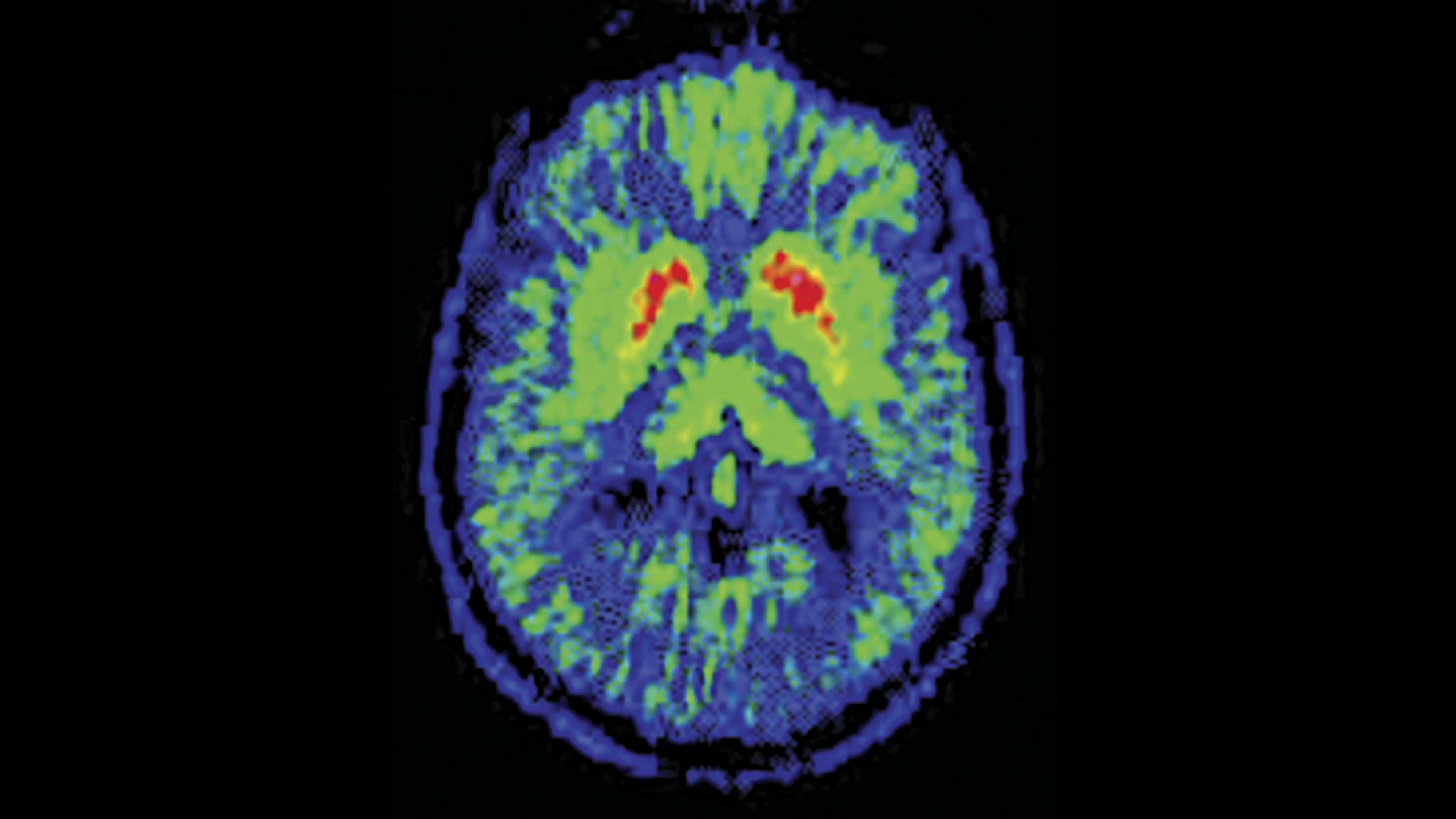 Prueba para detectar el mal de Parkinson