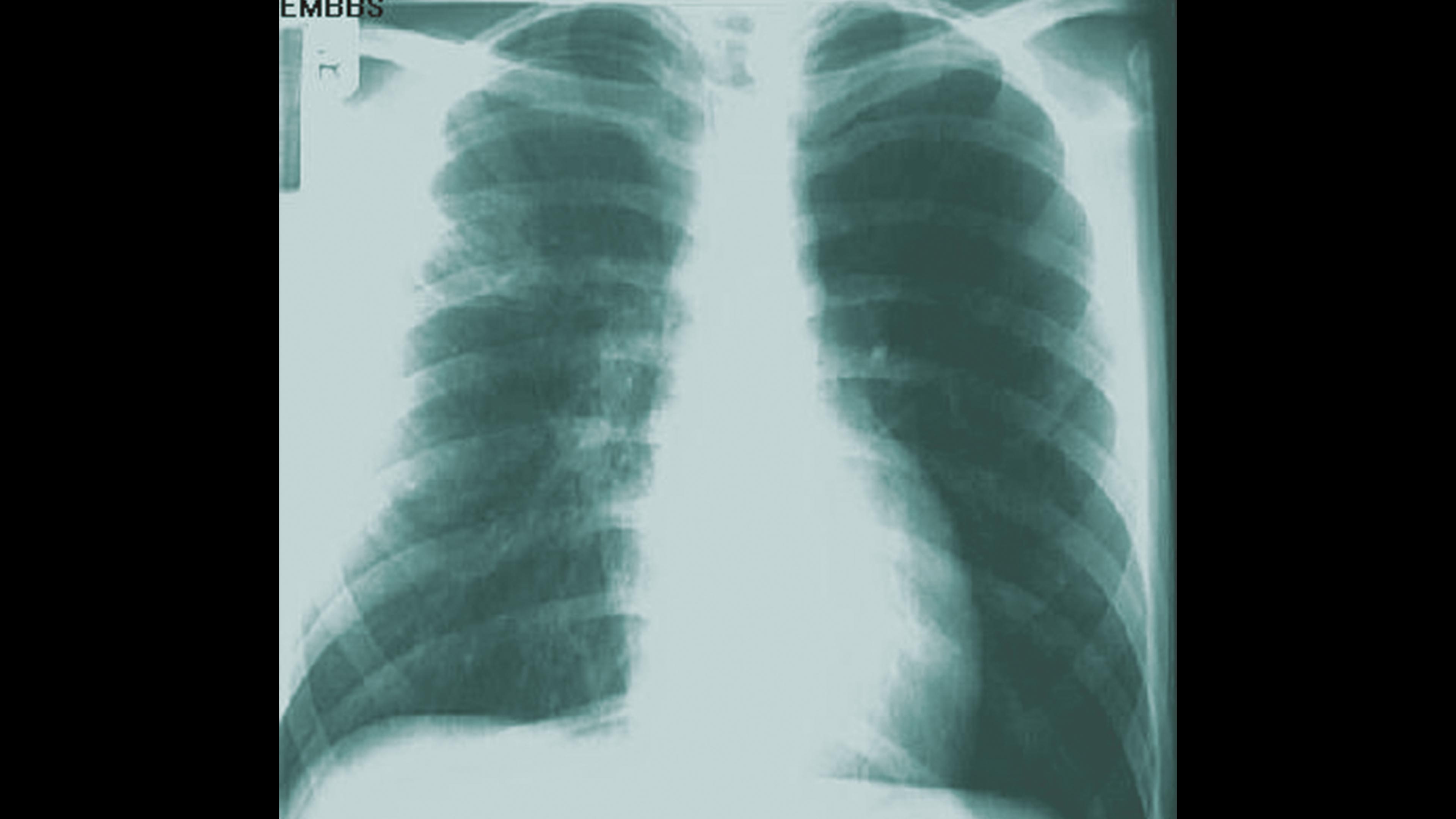 Vacuna contra la tuberculosis en la UNAM