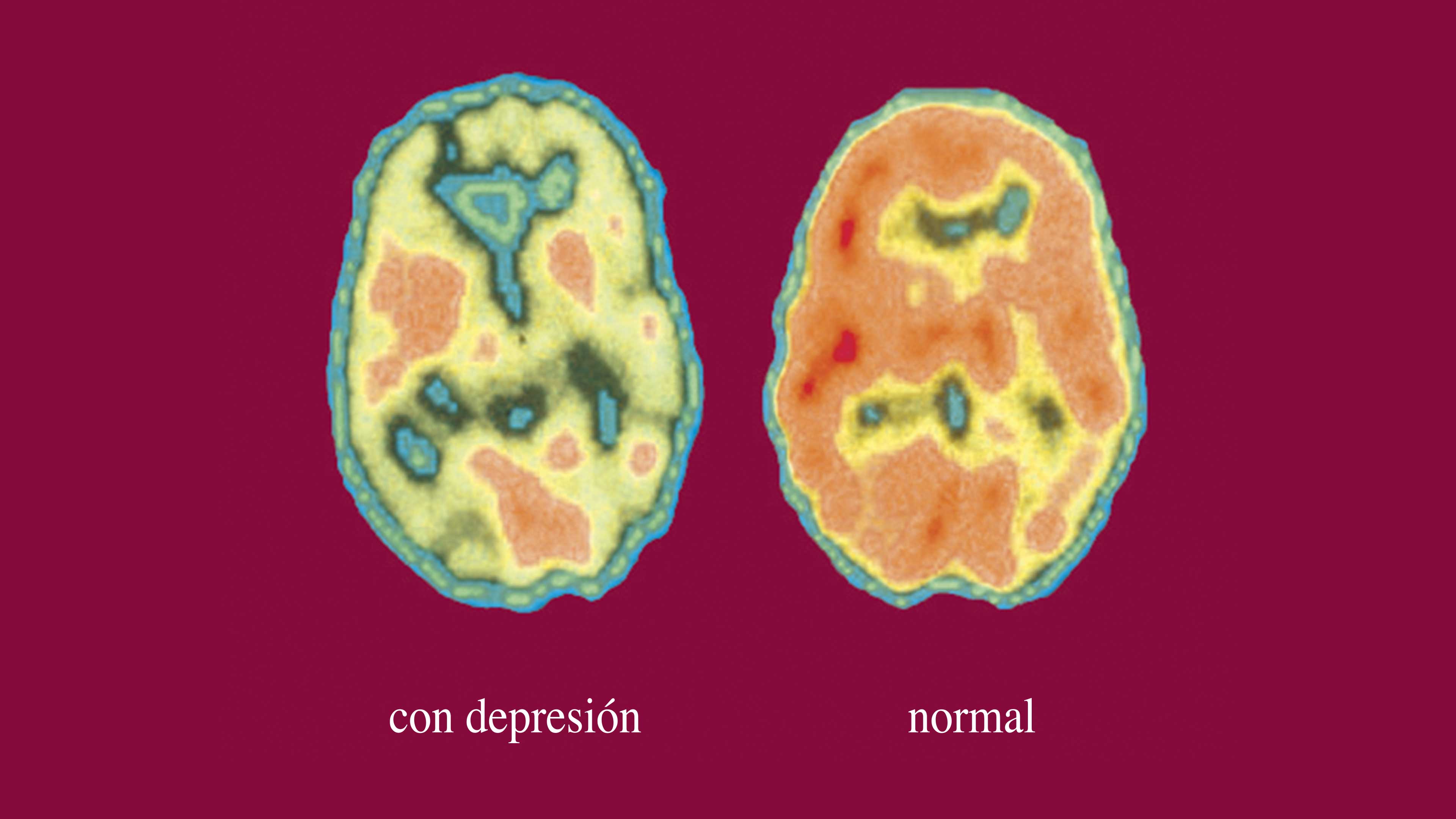 El cerebro y la depresión