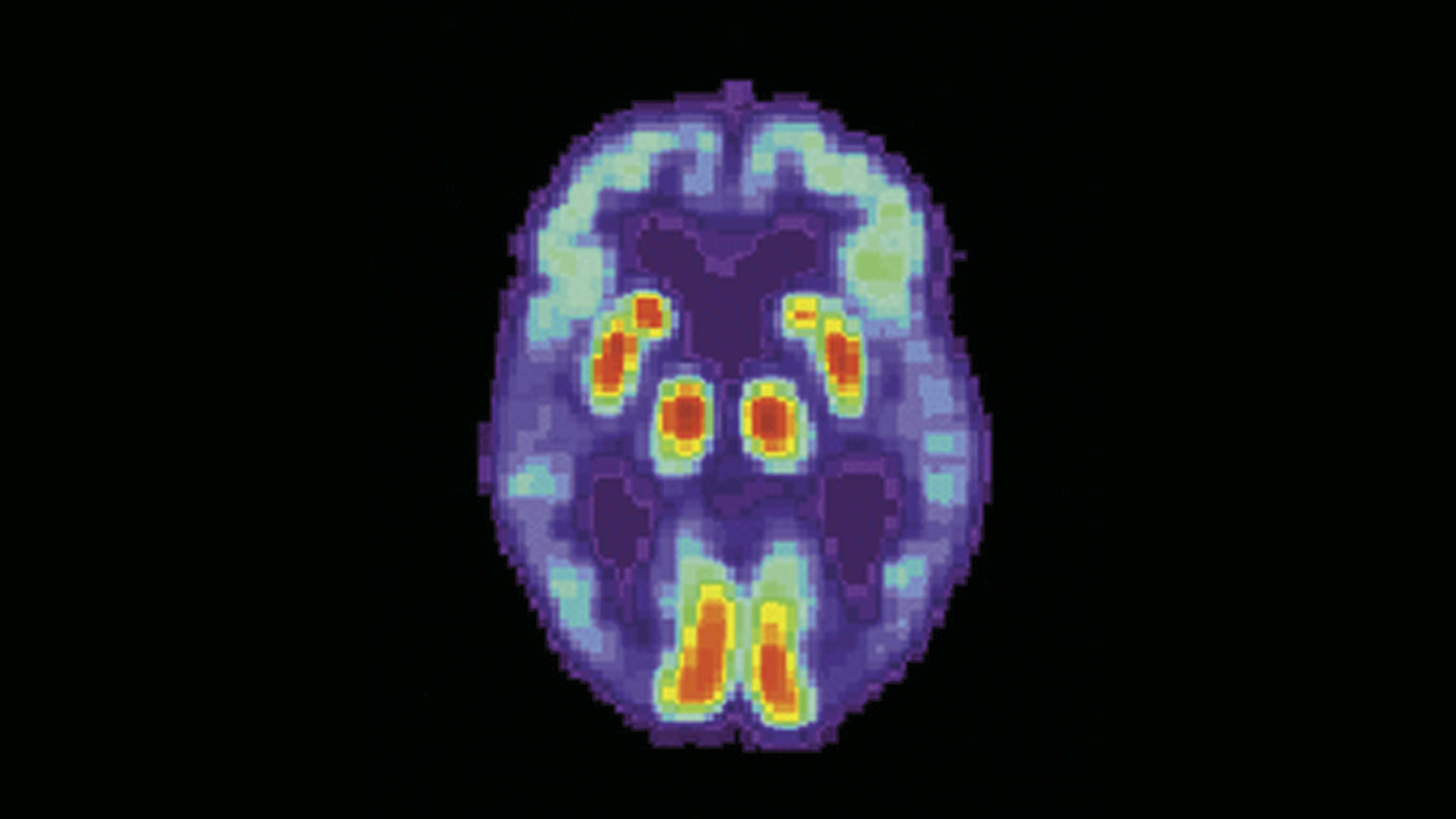 Medicamento contra VIH podría prevenir el Alzheimer