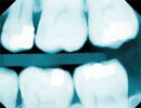 Imagen principal del artículo Caries, la batalla por los dientes*